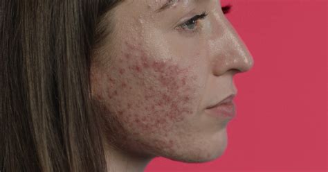 Bbc Three Skin Acne Birthmarks Eczema