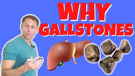 What Causes Gallstones And How To Treat Them Youtube