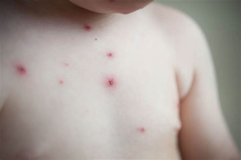 Signs Of Chickenpox Facty Health