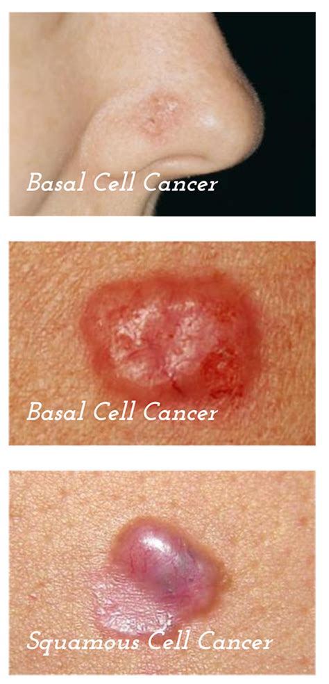 Signs of skin cancer differ in form, color and borders. What Does Skin Cancer Feel Like - CancerWalls
