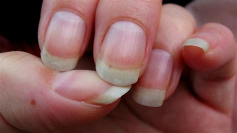 These ridges are often deep, and multiple lines may appear across the nail. What Causes Ridges in Fingernails? | Reference.com