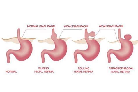10 Signs And Symptoms Of Hernia You Need To Know