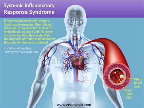 Systemic Inflammatory Response Syndromecausessymptomstreatment