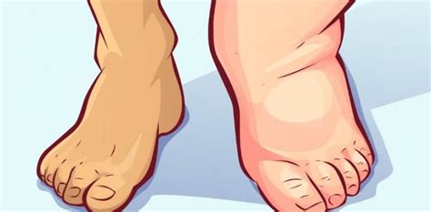 What Are Cankles And Tips On How To Get Rid Of Them