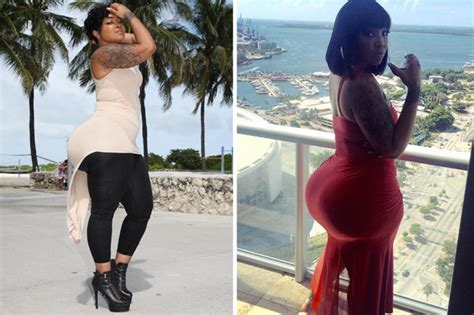 Woman Boosts Her Booty With Illegal Butt Shots Face Of Malawi
