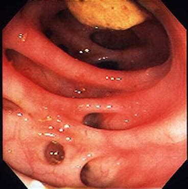 Gemelli, fue sometido esta noche a una operación quirúrgica programada para la estenosis diverticular del sigma, informó pasadas las. Revisión sobre diverticulitis a partir de un caso clínico - Monografias.com