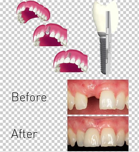 Tooth Dentistry Periodontist Periodontology X Ray PNG Clipart