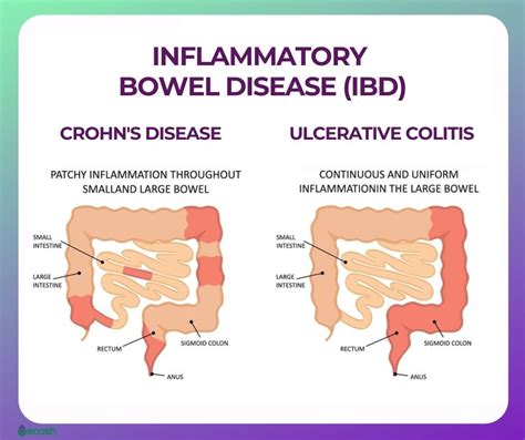 Inflammatory Bowel Disease Symptoms Causes Treatment