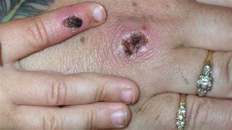 Monkeypox British Health Worker Infected With Rare Disease Cbc News