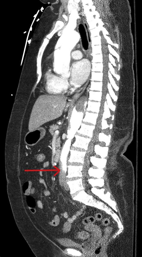 Acute Aortic Dissection Presenting As Bilateral Lower Extremity