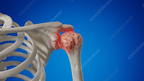 Arthritic Shoulder Joint Illustration Stock Image F0352819