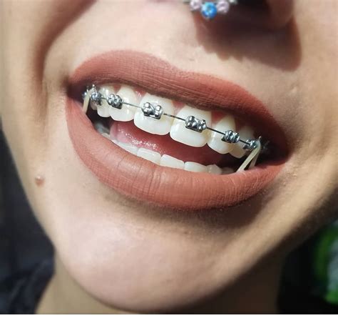 Braces Colors For Girls