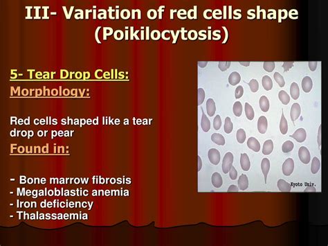 Ppt Rbcs Abnormal Morphology Powerpoint Presentation Id369630