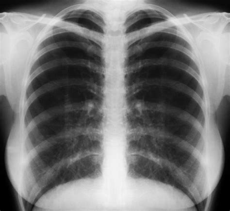 What Is A Tuberculosis Chest X Ray With Pictures