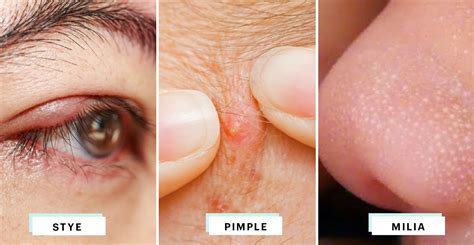 A Visual Guide To Identifying The Little Bump On Your Eyelid Pimple