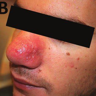 Cutaneous Leishmaniasis And Mucosal Leishmaniasis In A Traveler Download Scientific Diagram