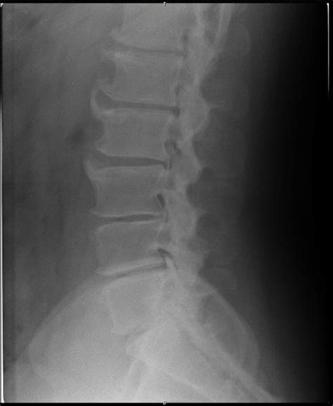 Representative Radiograph Of Anterior Lumbar Vertebral Osteophytes 72