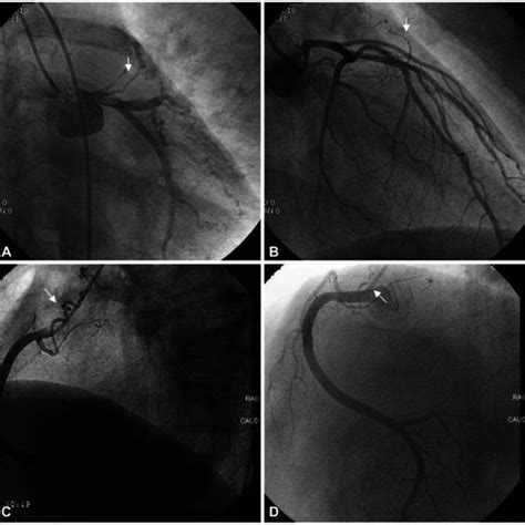 Follow Up Coronary Angiography At Two Years A And B Follow Up Left