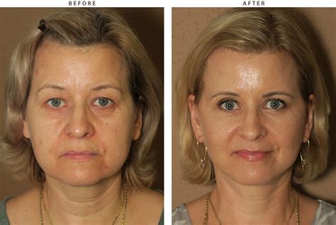 Buccal Fat Removal Cost Chicago Woehrsam