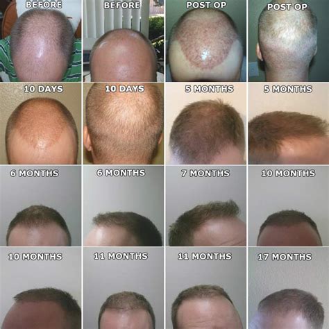Best Hair Transplant Toronto La Fontaine Cosmetic Surgery Clinic