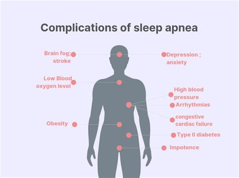 cureus the management of obstructive sleep apnea in primary care