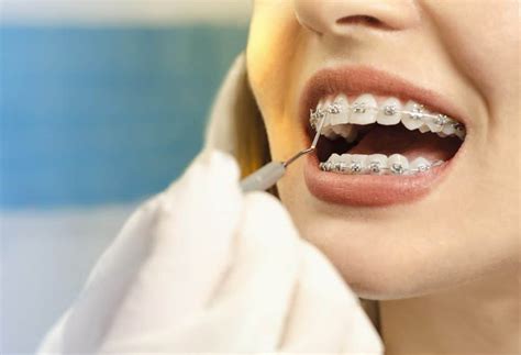 Common Braces Problems And How To Fix Them Andover Orthodontics