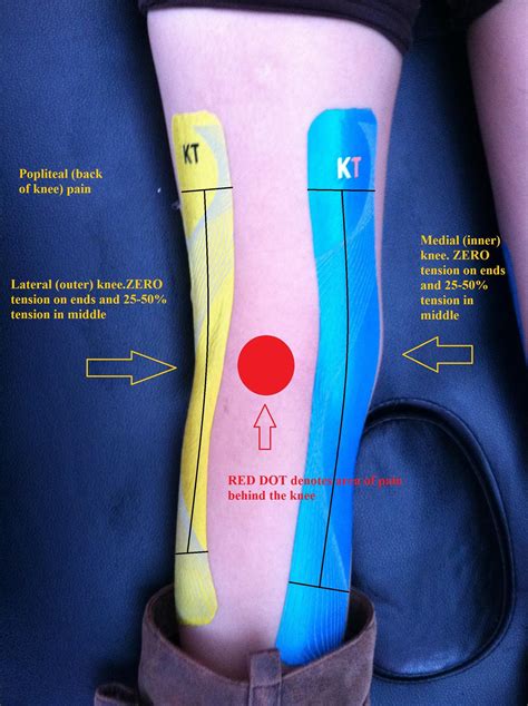 How To Kt Tape Knee For Inner Knee Pain