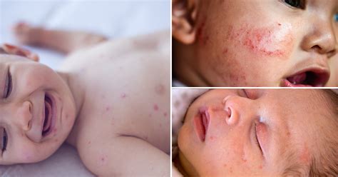 11 Effective Treatments To Cure Heat Rash In Toddlers