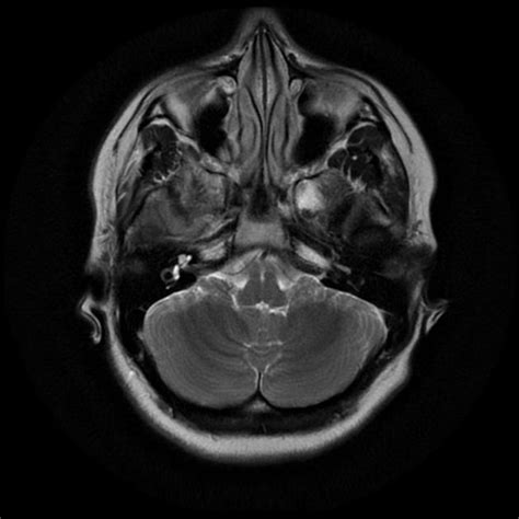 It can show tissues, organs and other structures inside your body. Normal brain (MRI) | Radiology Case | Radiopaedia.org ...