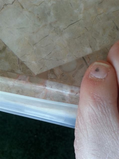 Dark Spot Under Toenail Melanoma Nail Ftempo