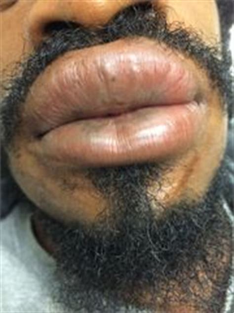 Angioedema is paroxysmal, nondemarcated swelling of dermal or submucosal layers of skin or mucosa. Angioedema - WikEM