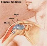 Medical Treatment For Tendonitis Pictures