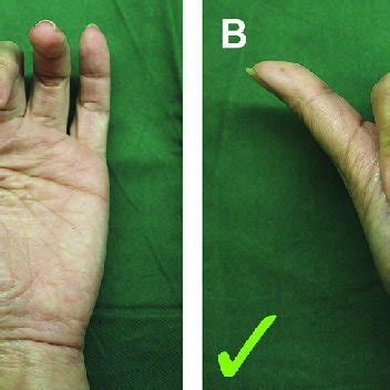 Alternative Flap Designs For Vy Advancement Flap A Crescent Flap