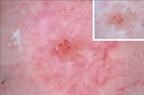 Semitranslucency In Dermoscopic Images Of Basal Cell Carcinoma