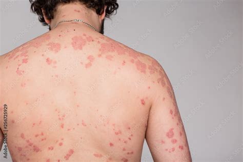 Psoriasis Skin Psoriasis Is An Autoimmune Disease That Affects The