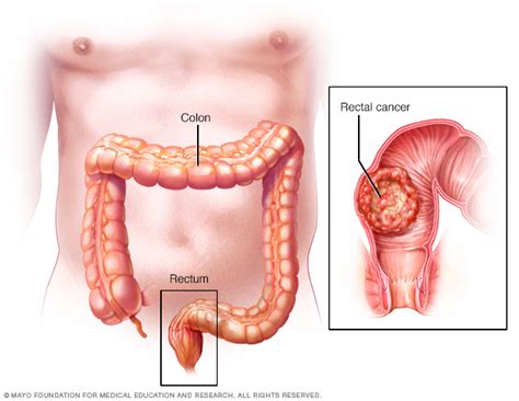 Rectal Cancer Disease Reference Guide