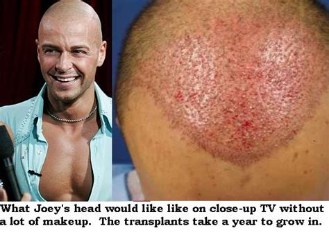 Insiders Agree “joey Lawrence Is Getting More Hair Transplants” The Damien Zone