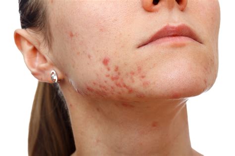 Acne Papules Causes Treatments Natural Remedies Dos And Donts