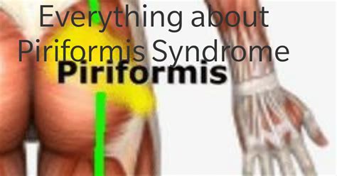 Everything About Piriformis Syndrome Physiotherapy Treatment