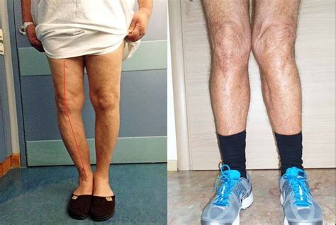 Knee Osteoarthritis An Overview Robert Howells