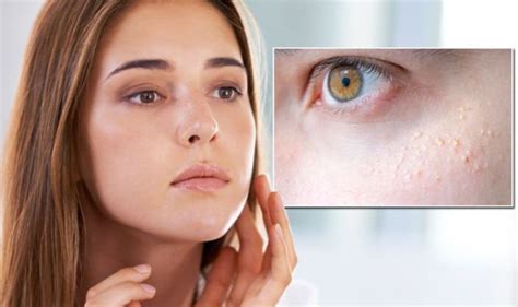 White Spots On Skin Expert Explains What Milia Are And Risk Of