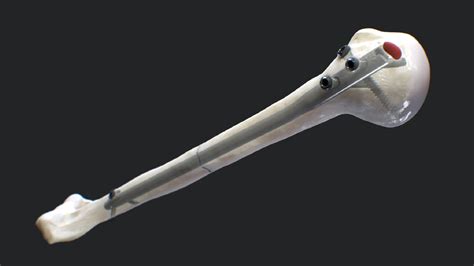 Arthrex Long Humeral Nail System Surgical Technique