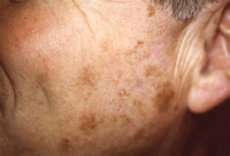 Liver Spots Pictures Causes Treatment Removal