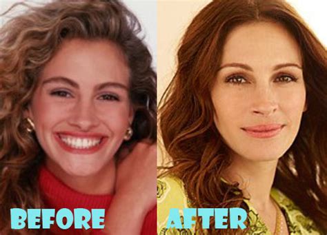 Julia Roberts Plastic Surgery Before And After Pictures Lovely