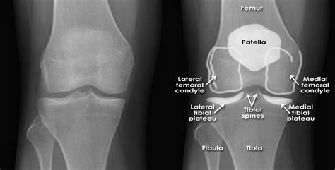 Trauma X Ray Lower Limb Knee