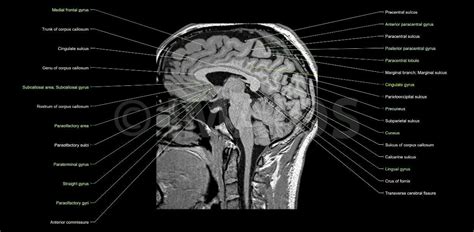 Anatomy Of The Brain Mri Mri Brain Brain Anatomy Mri