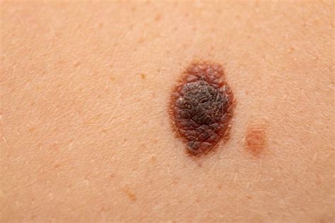 Liver Spot Stock Photos Pictures And Royalty Free Images Istock