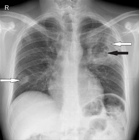 Chest X Ray Image Polysegmental Infiltration With Tissue Destruction