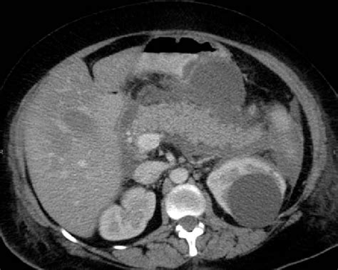 An Abdominal Computed Tomography Scan Showing A Diffuse Enlargement Of