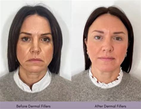 How To Get A Cheek Lift With Fillers Non Surgical Cheek Lift Cheek